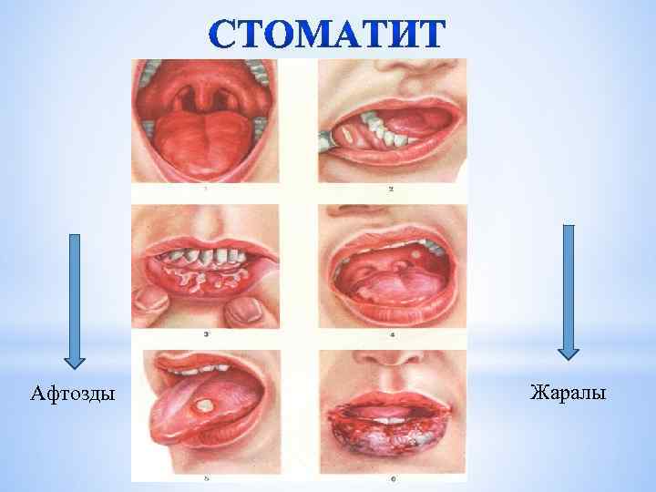 Афтозды Жаралы 