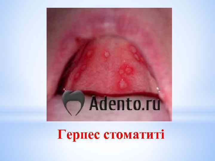 Герпес стоматиті 