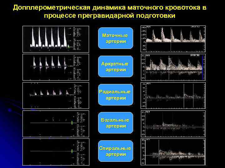 Допплерометрическая динамика маточного кровотока в процессе прегравидарной подготовки Маточные артерии Аркуатные артерии Радиальные артерии