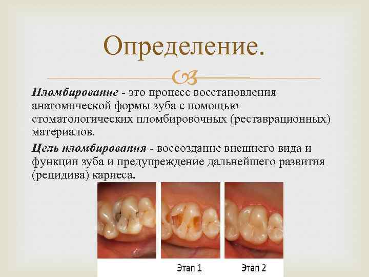 Определение. восстановления Пломбирование - это процесс анатомической формы зуба с помощью стоматологических пломбировочных (реставрационных)