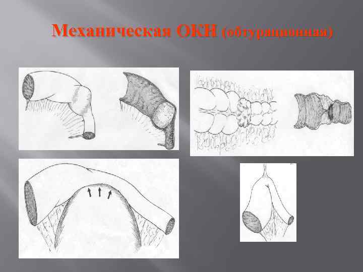 Механическая ОКН (обтурационная) 