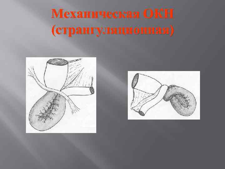 Механическая ОКН (странгуляционная) 