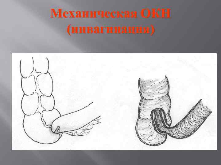 Механическая ОКН (инвагинация) 