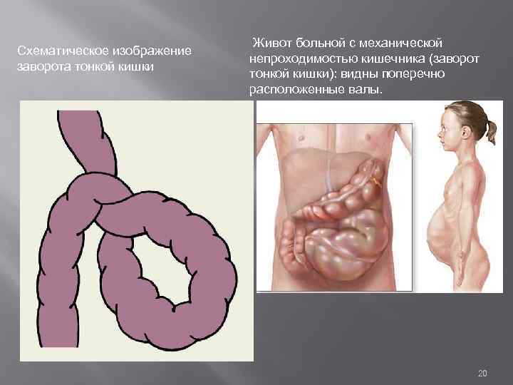 Схематическое изображение заворота тонкой кишки Живот больной с механической непроходимостью кишечника (заворот тонкой кишки):