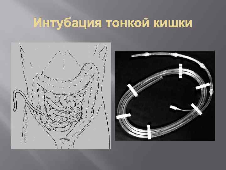 Интубация тонкой кишки 