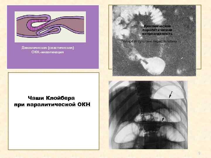 Динамическая паралитическая непроходимость Полное отсутствие перистальтики Динамическая (спастическая) ОКН. -инвагинация Чаши Клойбера при паралитической
