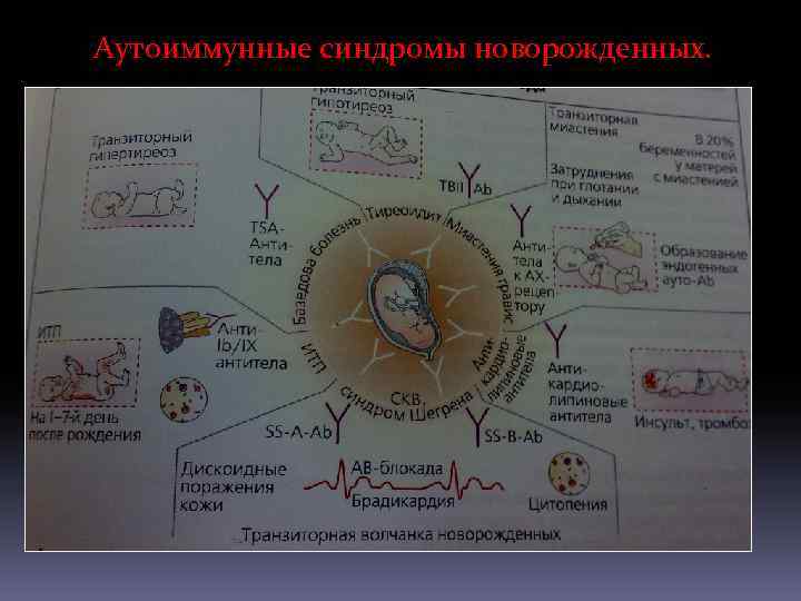 Аутоиммунные синдромы новорожденных. 