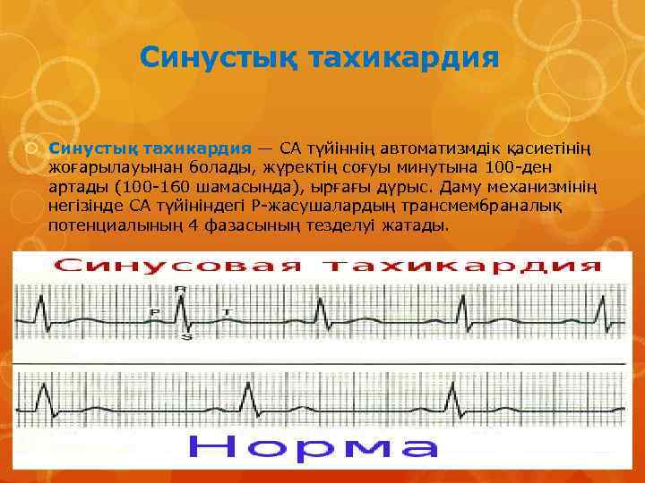 Синустық тахикардия — СА түйіннің автоматизмдік қасиетінің жоғарылауынан болады, жүректің соғуы минутына 100 -ден