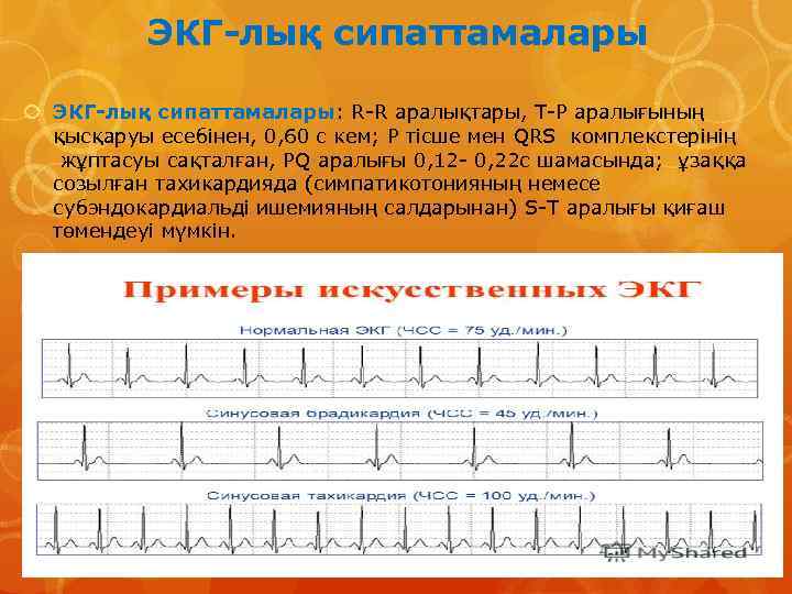 ЭКГ-лық сипаттамалары ЭКГ-лық сипаттамалары: R-R аралықтары, Т-Р аралығының қысқаруы есебінен, 0, 60 с кем;