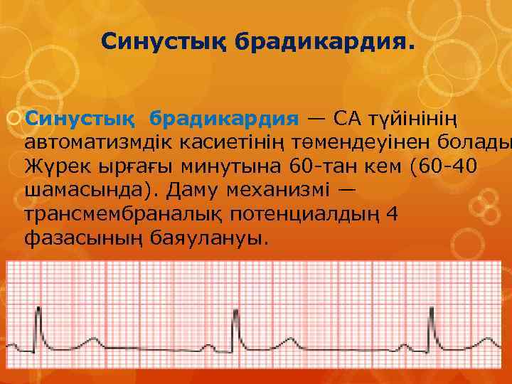 Синустық брадикардия — СА түйінінің автоматизмдік касиетінің төмендеуінен болады Жүрек ырғағы минутына 60 -тан