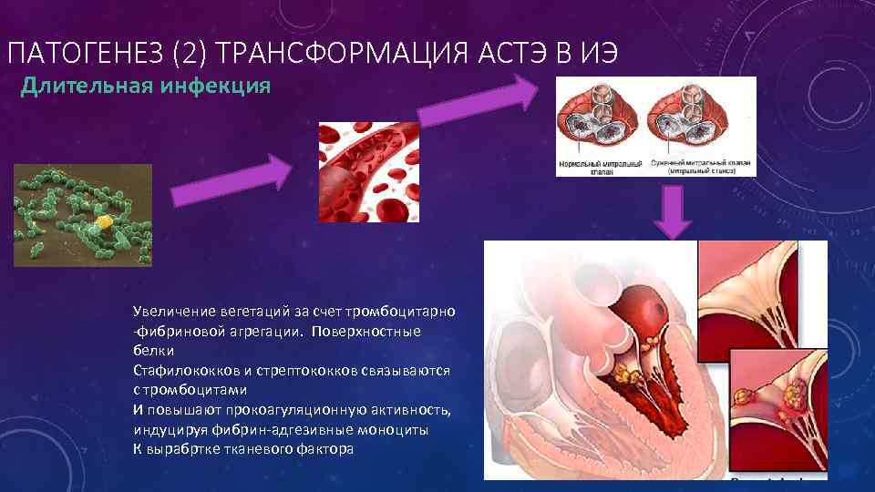 ПАТОГЕНЕЗ (2) ТРАНСФОРМАЦИЯ АСТЭ В ИЭ Длительная инфекция Увеличение вегетаций за счет тромбоцитарно -фибриновой