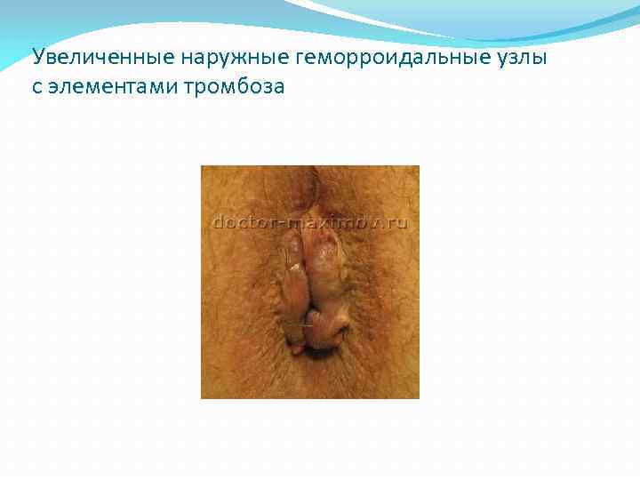 Увеличенные наружные геморроидальные узлы с элементами тромбоза 