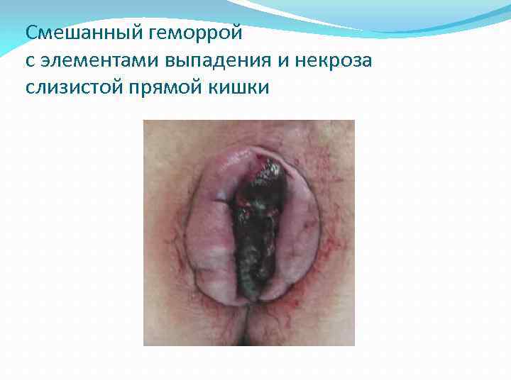 Смешанный геморрой с элементами выпадения и некроза слизистой прямой кишки 