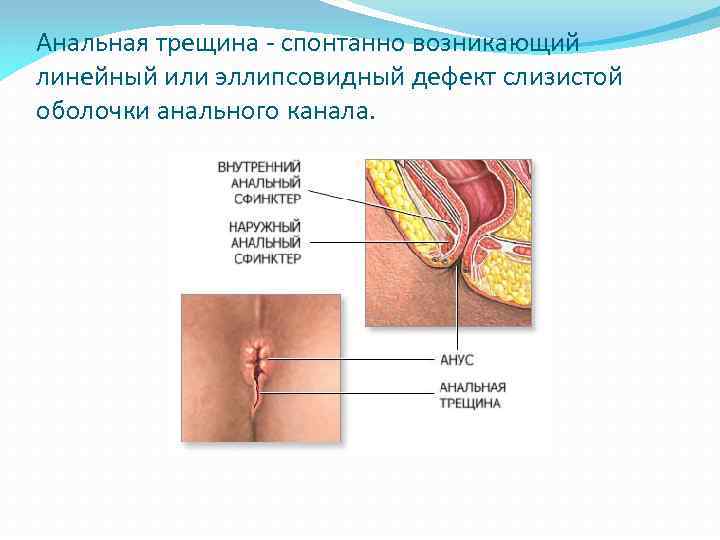 Анальная трещина - спонтанно возникающий линейный или эллипсовидный дефект слизистой оболочки анального канала. 