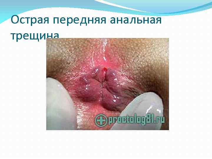 Острая передняя анальная трещина 