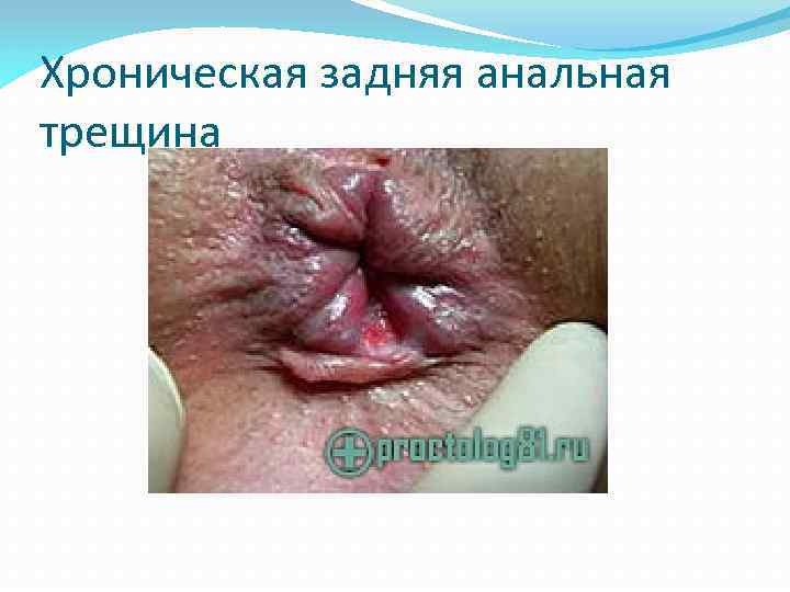 Хроническая задняя анальная трещина 