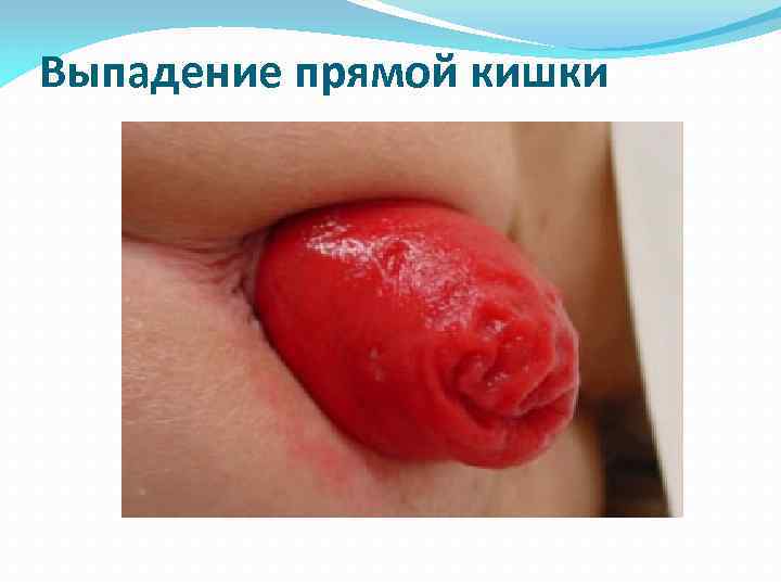 Выпадение прямой кишки 