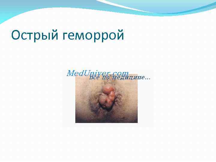 Острый геморрой 