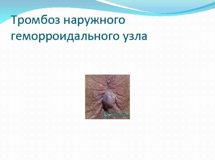 Тромбоз наружного геморроидального узла 