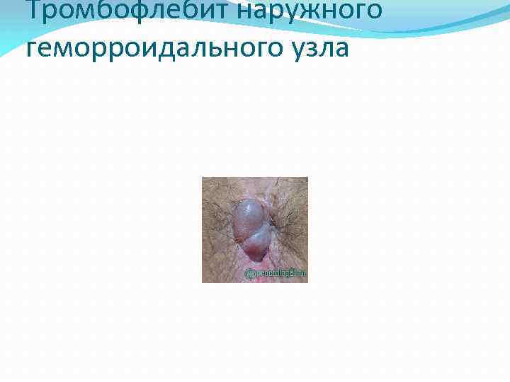 Тромбофлебит наружного геморроидального узла 