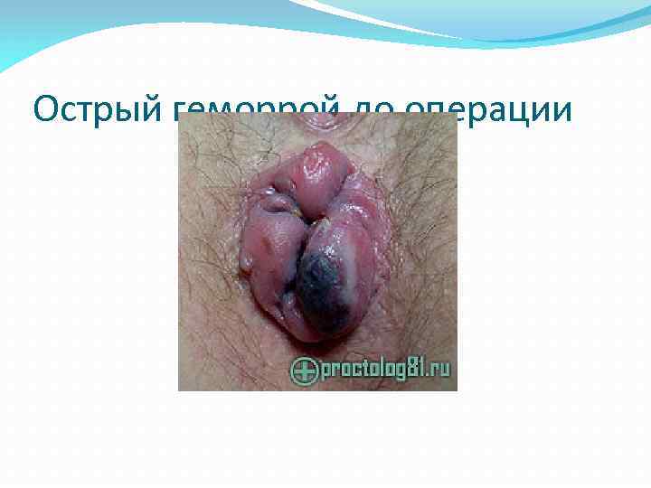 Острый геморрой до операции 