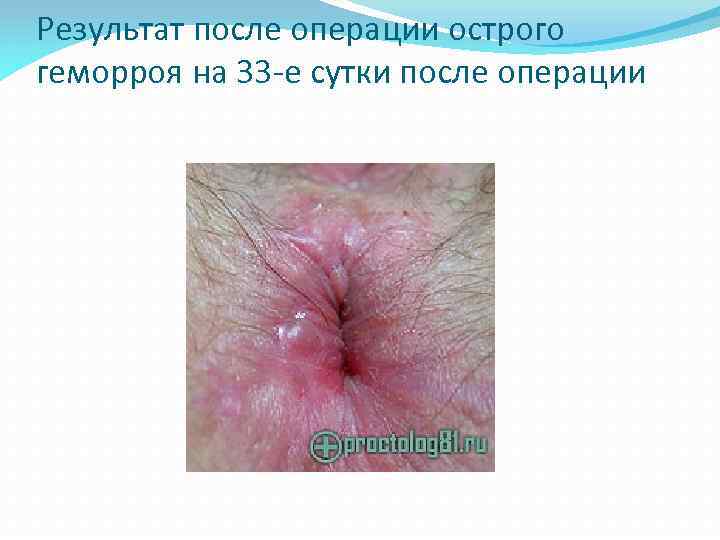 Результат после операции острого геморроя на 33 -е сутки после операции 