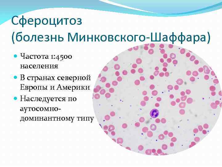 Сфероцитоз (болезнь Минковского-Шаффара) Частота 1: 4500 населения В странах северной Европы и Америки Наследуется