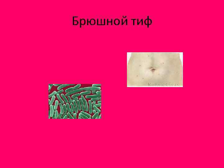 Брюшной тиф 