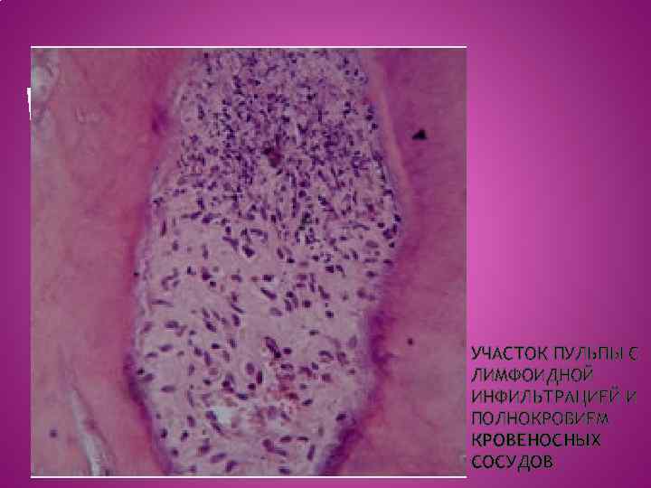 Ораска гемоток силинэозин УЧАСТОК ПУЛЬПЫ С ЛИМФОИДНОЙ ИНФИЛЬТРАЦИЕЙ И ПОЛНОКРОВИЕМ КРОВЕНОСНЫХ СОСУДОВ 