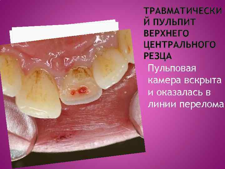 ТРАВМАТИЧЕСКИ Й ПУЛЬПИТ ВЕРХНЕГО ЦЕНТРАЛЬНОГО РЕЗЦА Пульповая камера вскрыта и оказалась в линии перелома