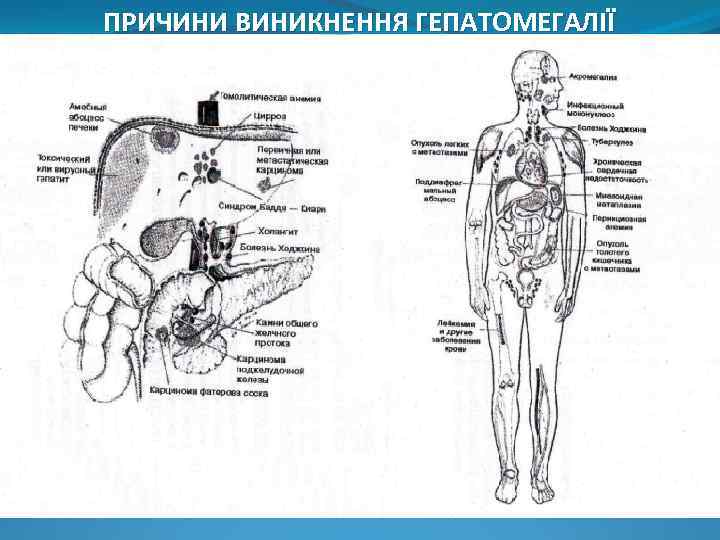 ПРИЧИНИ ВИНИКНЕННЯ ГЕПАТОМЕГАЛІЇ 