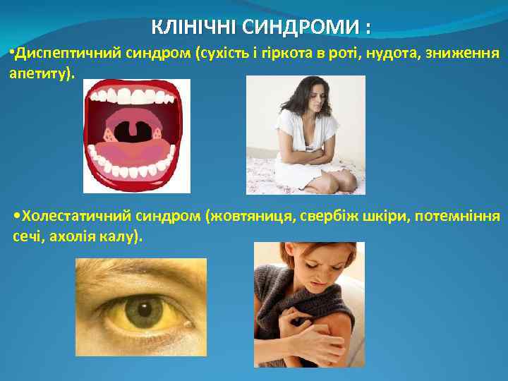 КЛІНІЧНІ СИНДРОМИ : • Диспептичний синдром (сухість і гіркота в роті, нудота, зниження апетиту).