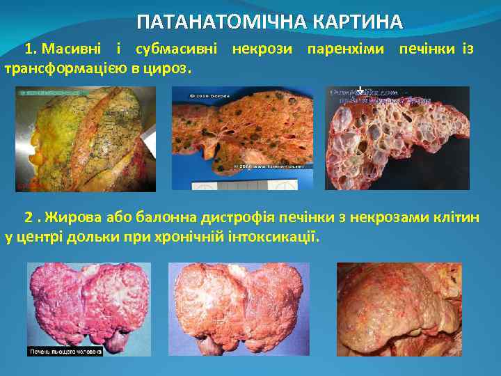 ПАТАНАТОМІЧНА КАРТИНА 1. Масивні і субмасивні некрози паренхіми печінки із трансформацією в цироз. 2.