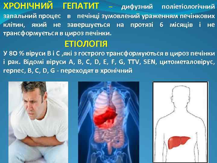 ХРОНІЧНИЙ ГЕПАТИТ – дифузний поліетіологічний запальний процес в печінці зумовлений ураженням печінкових клітин, який