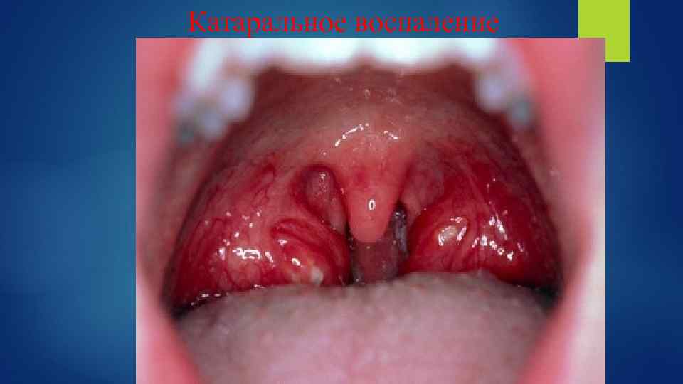 Катаральное воспаление 