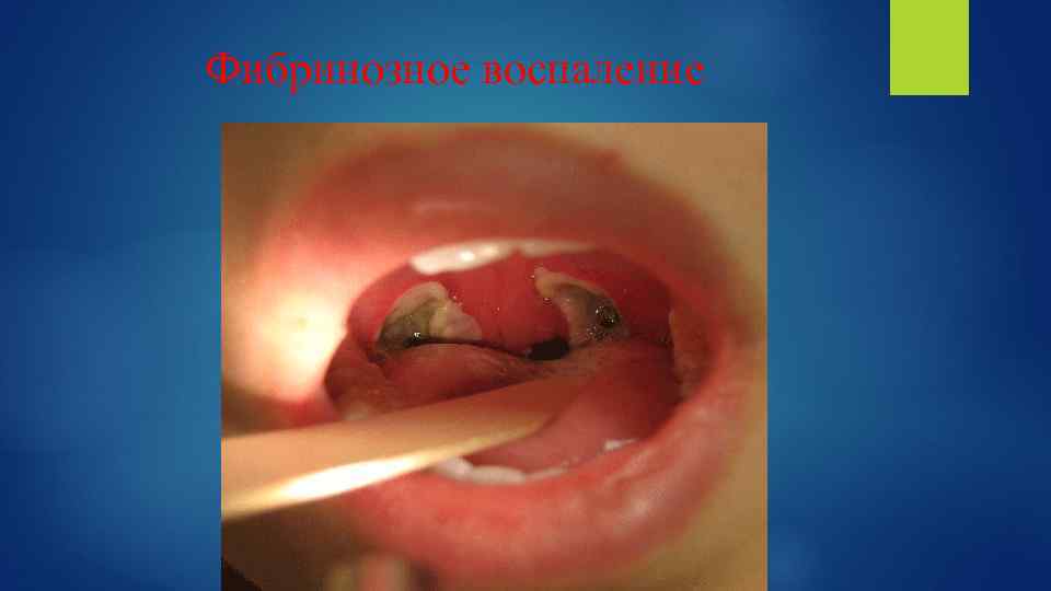 Фибринозное воспаление 