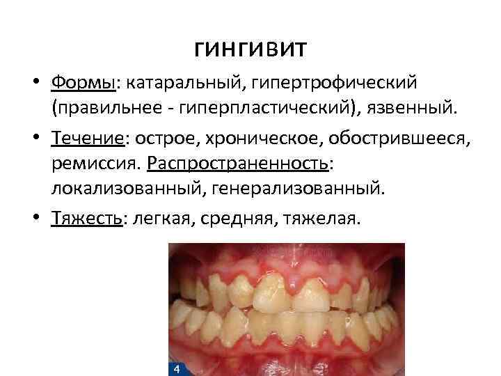 гингивит • Формы: катаральный, гипертрофический (правильнее - гиперпластический), язвенный. • Течение: острое, хроническое, обострившееся,