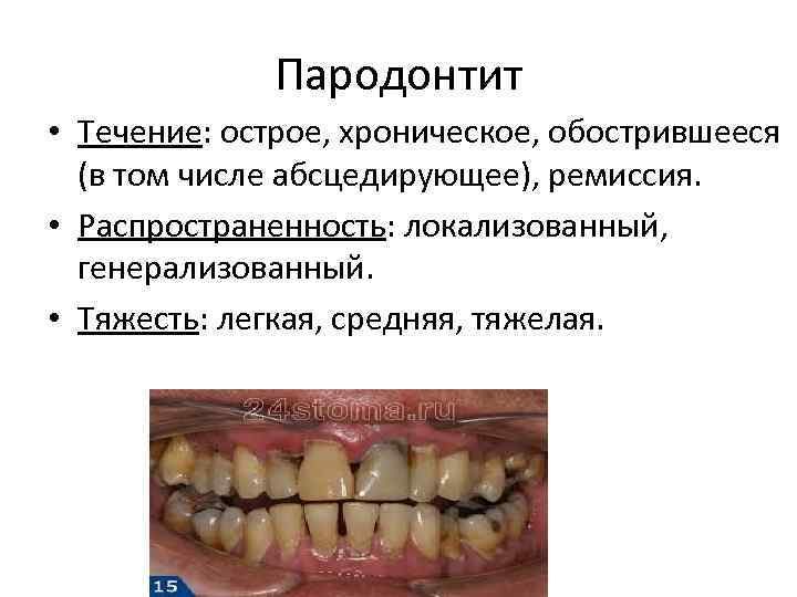 Пародонтит • Течение: острое, хроническое, обострившееся (в том числе абсцедирующее), ремиссия. • Распространенность: локализованный,