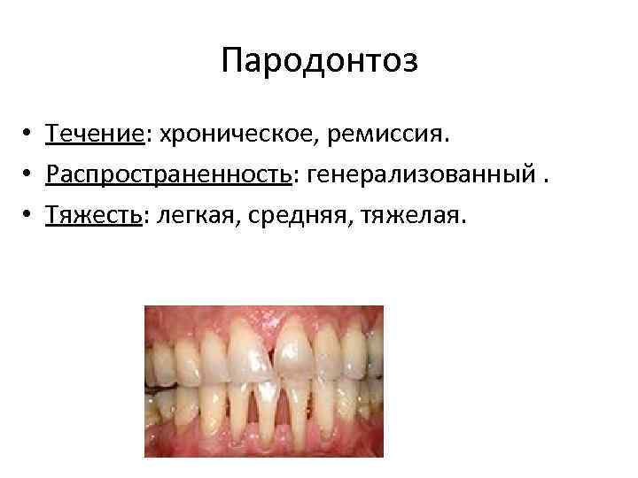 Пародонтоз • Течение: хроническое, ремиссия. • Распространенность: генерализованный. • Тяжесть: легкая, средняя, тяжелая. 