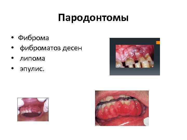 Пародонтомы • • Фиброма фиброматоз десен липома эпулис. 