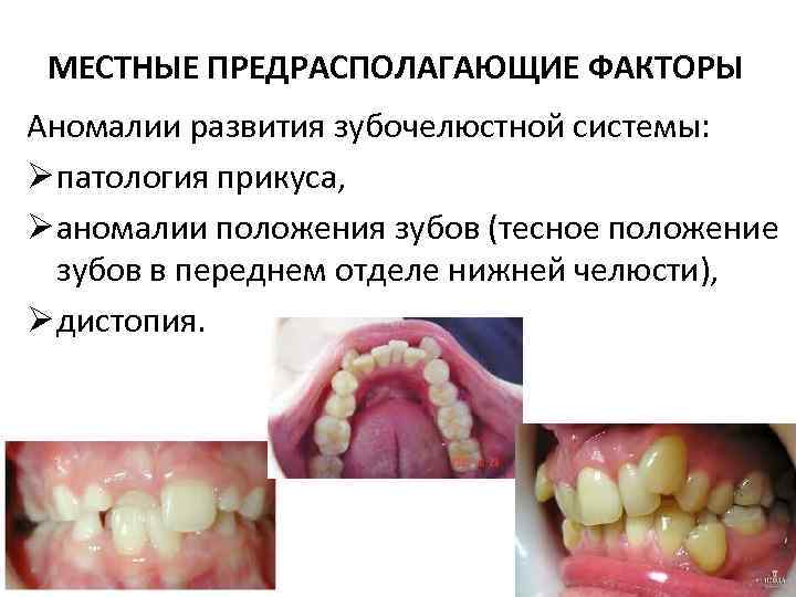 МЕСТНЫЕ ПРЕДРАСПОЛАГАЮЩИЕ ФАКТОРЫ Аномалии развития зубочелюстной системы: Ø патология прикуса, Ø аномалии положения зубов