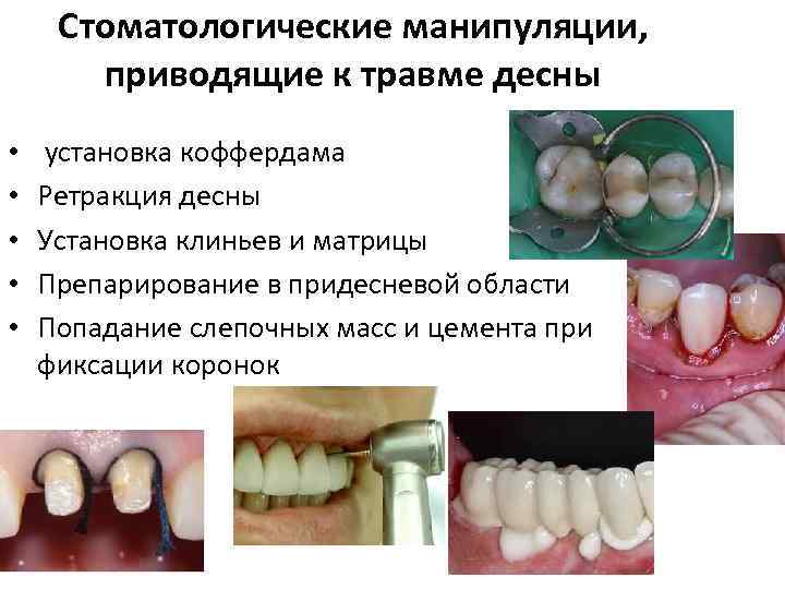 Стоматологические манипуляции, приводящие к травме десны • • • установка коффердама Ретракция десны Установка