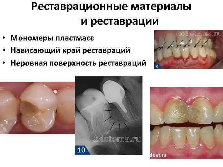 Реставрационные материалы и реставрации • Мономеры пластмасс • Нависающий край реставраций • Неровная поверхность