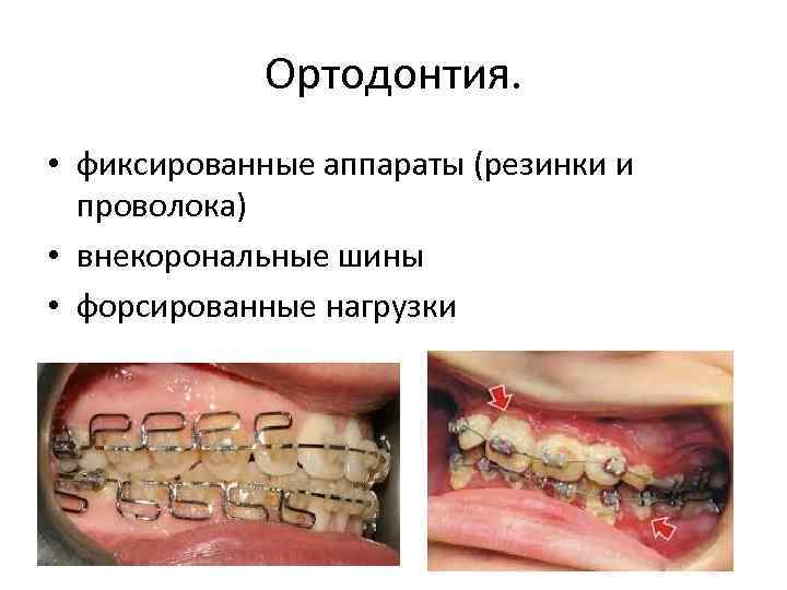 Ортодонтия. • фиксированные аппараты (резинки и проволока) • внекорональные шины • форсированные нагрузки 