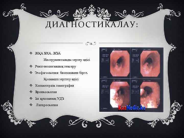 ДИАГНОСТИКАЛАУ: v ЖҚА БХА. ЖЗА Инструментальды зертеу әдісі v Рентгенологиялық тексеру v Эзофагоскопия биопсиямен
