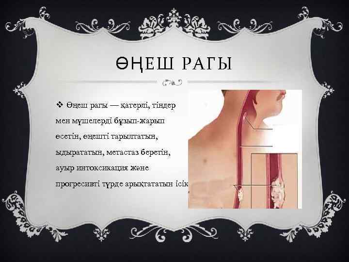 ӨҢЕШ РАГЫ v Өңеш рагы — қатерлі, тіндер мен мүшелерді бұзып-жарып өсетін, өңешті тарылтатын,