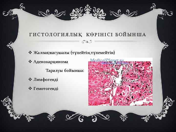 ГИСТОЛОГИЯЛЫҚ КӨРІНІСІ БОЙЫНША v Жалпақжасушалы (түлейтін, түлемейтін) v Аденокарцинома Таралуы бойынша: v Лимфогенді v