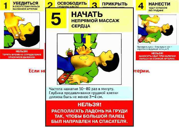 Внезапная смерть. Если нет сознания и нет пульса на сонной артерии. 