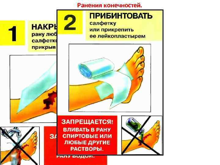 Ранения конечностей. Как накладывать повязки на раны. 