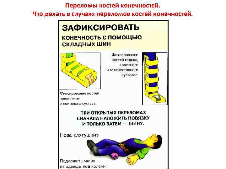 Переломы костей конечностей. Что делать в случаях переломов костей конечностей. 